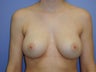 Breast Augmentation