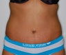 Tummy Tuck