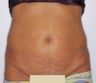 Tummy Tuck