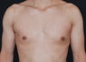 Gynecomastia
