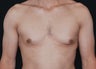Gynecomastia
