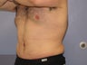 Male Tummy Tuck