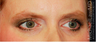 Eyelid Surgery - Blepharoplasty