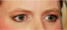 Eyelid Surgery - Blepharoplasty