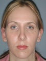 Otoplasty, Ear Surgery