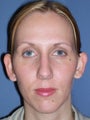 Otoplasty, Ear Surgery