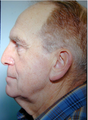 SMAS Facelift