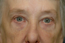 Browlift with upper and lower blepharoplasty.