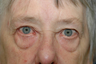 Browlift with upper and lower blepharoplasty.