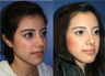 21 year Old Female, primary Rhinoplasty
