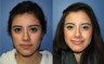 21 year Old Female, primary Rhinoplasty