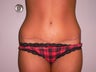 Tummy Tuck