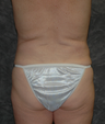 Vaser Liposuction