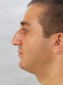 Rhinoplasty
