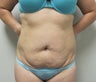Tummy Tuck