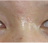 Scar Removal