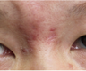Scar Removal