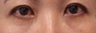 Bilateral Lower Blepharoplasty