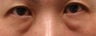 Bilateral Lower Blepharoplasty