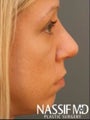 Female Revision Rhinoplasty 