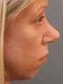 Female Revision Rhinoplasty 