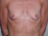32 yr old woman with Saline Breast Implants