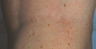 Vein Treatment