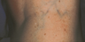 Vein Treatment