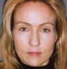 Botox