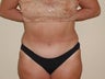 Tummy Tuck