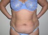 Tummy Tuck