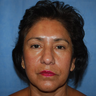 Brow Lift