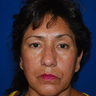 Brow Lift