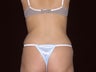 40 Year Old Female Liposuction Hips