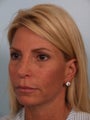 Brow Lift