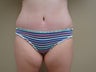 Mini Tummy Tuck (Skin Only)