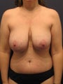Breast lift in 40 year old woman
