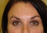 Botox