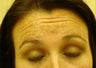 Botox
