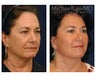 Eyelid Surgery - Blepharoplasty