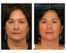 Eyelid Surgery - Blepharoplasty