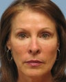 Juvederm
