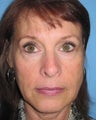 Juvederm