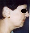 46 year old female patient 