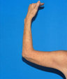 Arm Lift