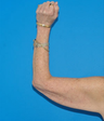 Arm Lift
