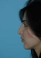 Rhinoplasty