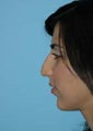 Rhinoplasty
