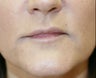 Juvederm into downturned corners of mouth