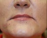 Juvederm into downturned corners of mouth
